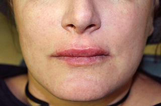 After Juvederm